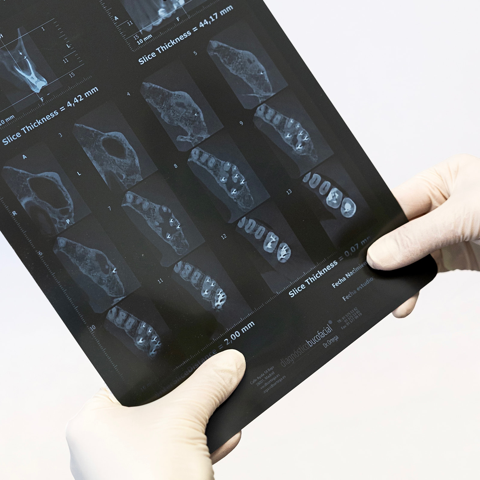 Radiografía dental sostenida por manos con guantes, mostrando múltiples cortes transversales de dientes y mandíbula con diferentes grosores de corte indicados en milímetros